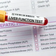 Próbówka z krwią do badania "LIVER FUNCTION TEST" leży na formularzu z listą parametrów, w tym ALT, AST, GGT. Wyniki mogą być podwyższone.