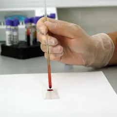 Ręka w rękawiczce pobiera próbkę krwi do analizy, która może wykazać poziom kreatyniny w surowicy.