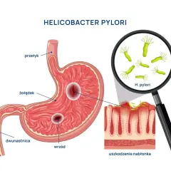 Ilustracja przedstawia żołądek z wrzodami i bakterie Helicobacter pylori. Szukając najskuteczniejszego leku na helicobacter, warto zrozumieć jego działanie.