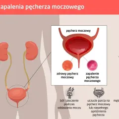 Objawy zapalenia pęcherza: nietrzymanie moczu, ból, pieczenie, parcie, gorączka, mętny mocz.