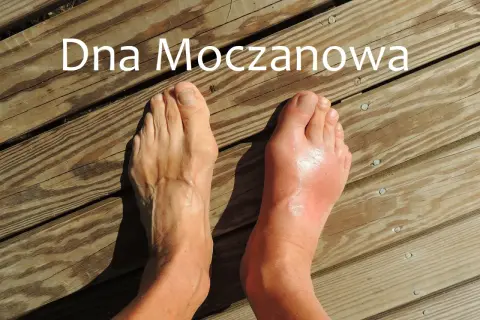 Dna moczanowa powoduje ból pięty i obrzęk stopy.