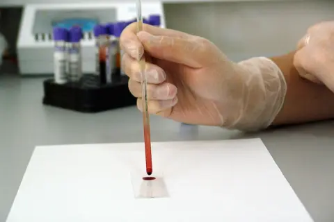 Ręka w rękawiczce pobiera próbkę krwi do analizy, która może wykazać poziom kreatyniny w surowicy.
