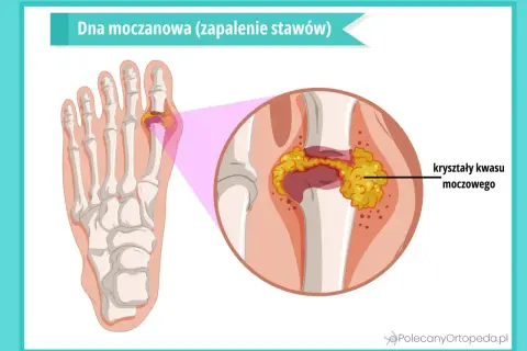 Dna moczanowa, zwana chorobą królów, to zapalenie stawów spowodowane kryształami kwasu moczowego w paluchu.