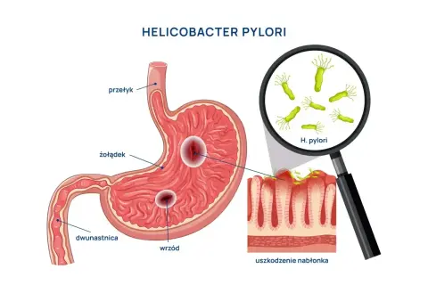 Ilustracja przedstawia żołądek z wrzodami i bakterie Helicobacter pylori. Szukając najskuteczniejszego leku na helicobacter, warto zrozumieć jego działanie.