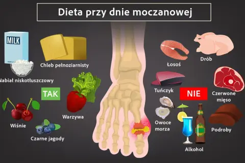 Dieta przy dnie moczanowej: nabiał, chleb pełnoziarnisty, warzywa, wiśnie, czarne jagody - TAK. Unikaj łososia, tuńczyka, drobiu, czerwonego mięsa, podrobów, owoców morza, alkoholu.