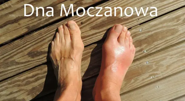 Dna moczanowa powoduje ból pięty i obrzęk stopy.