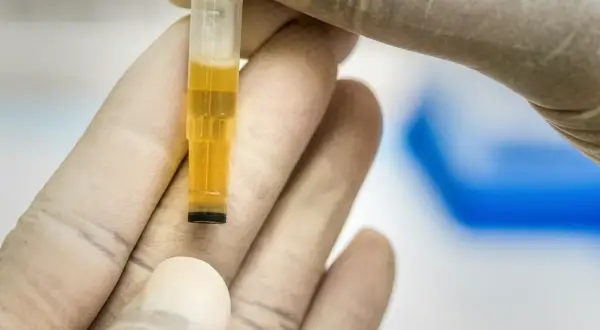 Rękawiczki laboratoryjne trzymają probówkę z żółtym płynem, wskazującym na leukocyty w moczu podwyższone.