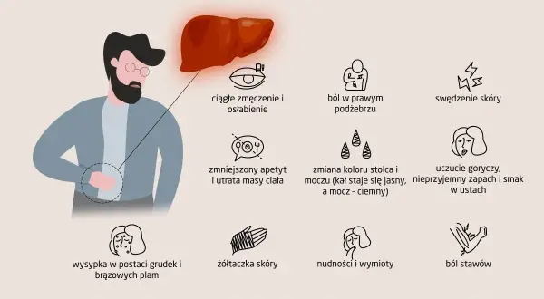 Ilustracja przedstawia objawy chorób wątroby, takie jak zmęczenie, ból, swędzenie skóry, nudności, żółtaczka. Zapalenie wątroby może objawiać się na wiele sposobów.