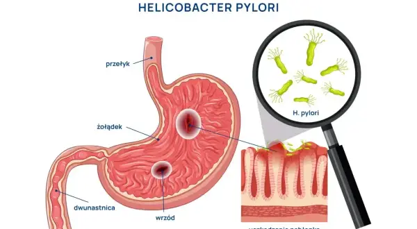 Ilustracja przedstawia żołądek z wrzodami i bakterie Helicobacter pylori. Szukając najskuteczniejszego leku na helicobacter, warto zrozumieć jego działanie.