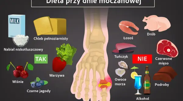 Dieta przy dnie moczanowej: nabiał, chleb pełnoziarnisty, warzywa, wiśnie, czarne jagody - TAK. Unikaj łososia, tuńczyka, drobiu, czerwonego mięsa, podrobów, owoców morza, alkoholu.