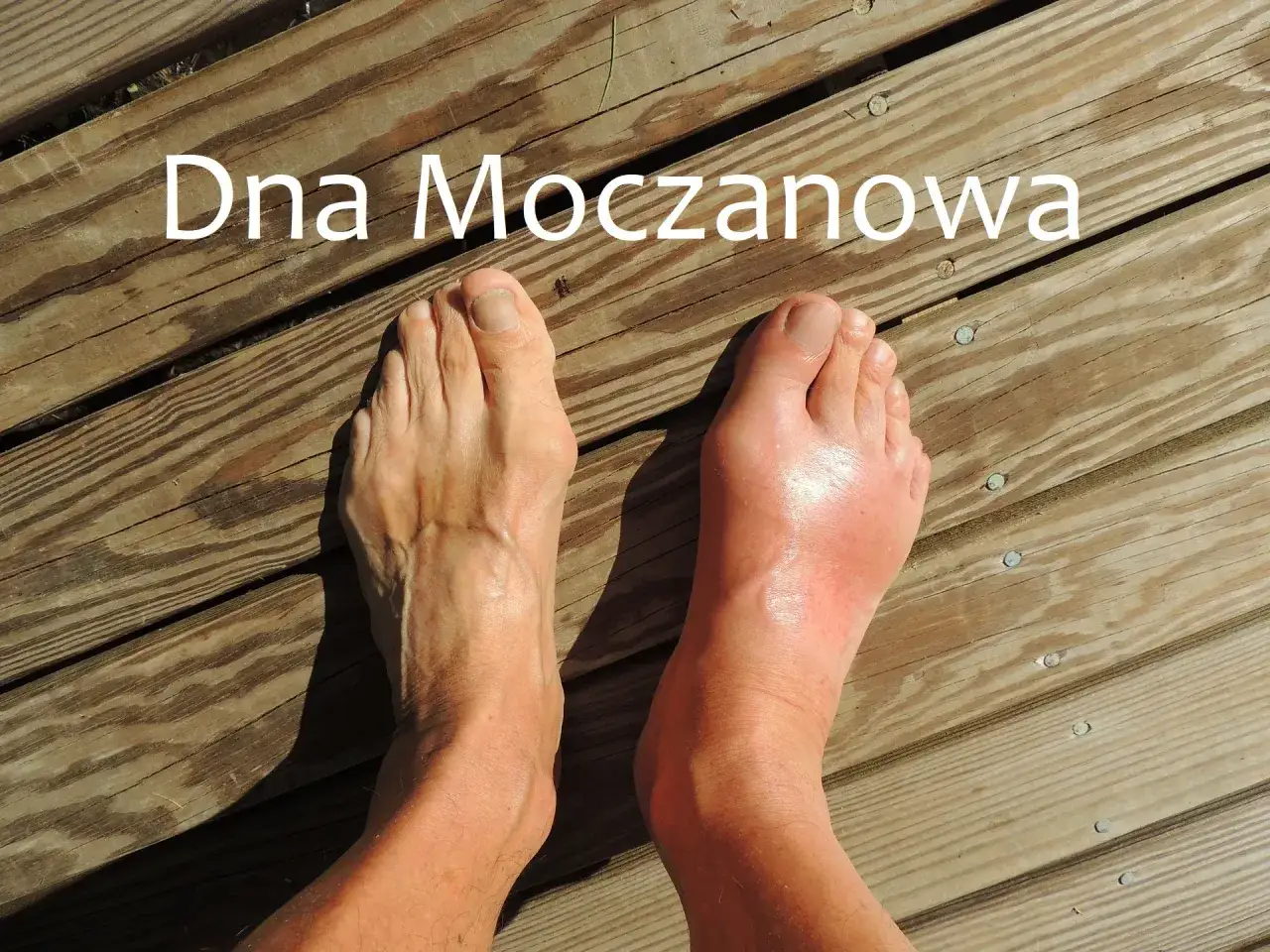 Dna moczanowa utrudnia chodzenie. Prawa stopa jest opuchnięta i zaczerwieniona, co świadczy o ataku dny.