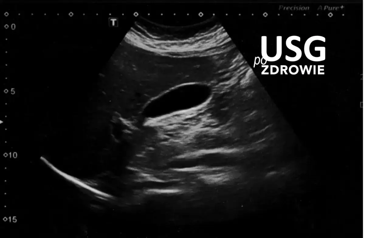 USG jamy brzusznej: widoczna pusta jama pęcherzyka żółciowego, bez oznak kamicy żółciowej.