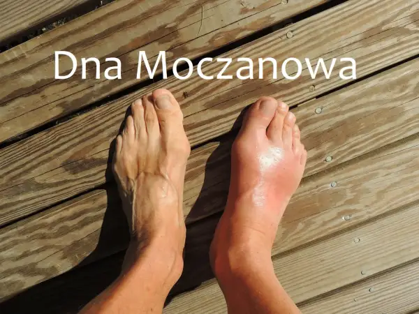 Dna moczanowa powoduje ból pięty i obrzęk stopy.