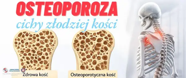 Osteoporoza: cichy złodziej kości. Porównanie zdrowej i osteoporotycznej kości. Szkielet z zaznaczonym bólem w obrębie barku.