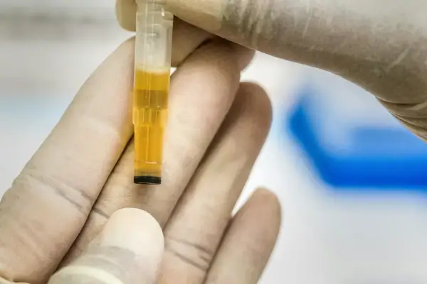 Rękawiczki laboratoryjne trzymają probówkę z żółtym płynem, wskazującym na leukocyty w moczu podwyższone.