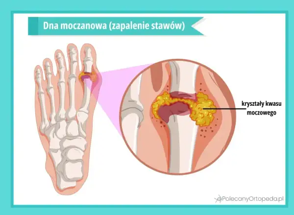 Dna moczanowa, zwana chorobą królów, to zapalenie stawów spowodowane kryształami kwasu moczowego w paluchu.