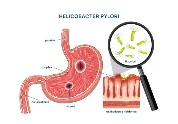Ilustracja przedstawia żołądek z wrzodami i bakterie Helicobacter pylori. Szukając najskuteczniejszego leku na helicobacter, warto zrozumieć jego działanie.
