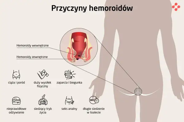 Przyczyny hemoroidów: ciąża, wysiłek fizyczny, zaparcia, biegunka, nieprawidłowe odżywianie, siedzący tryb życia, seks analny, długie siedzenie w toalecie.