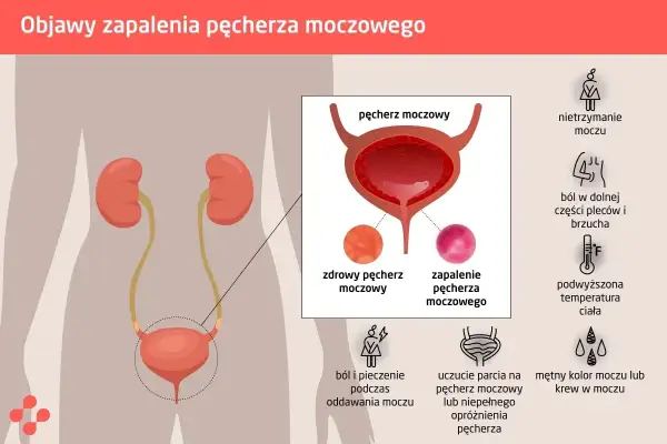 Objawy zapalenia pęcherza: nietrzymanie moczu, ból, pieczenie, parcie, gorączka, mętny mocz.